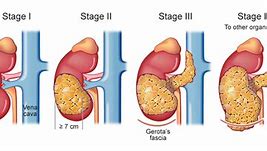 Image result for Stage 4 Renal Cancer