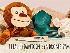 Image result for Fetal Hydantoin Syndrome
