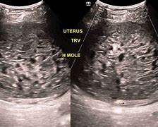 Image result for Hydatidiform Mole Ultrasound