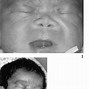 Image result for Normal vs Fetal Warfarin Syndrome