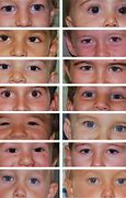 Image result for XYY Pictures Jacobs Syndrome