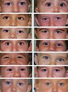 Image result for Boy with XYY Syndrome