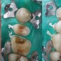 Image result for Flossing Bonded Teeth