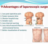 Image result for Lap Appy Procedure