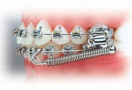 Image result for Fixed Orthodontic Appliance