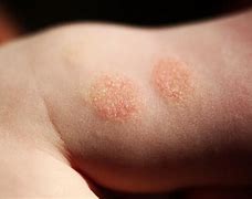 Image result for Derma Eczema