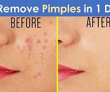 Image result for How to Clear Pimples