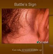 Image result for Mastoid Battle Sign