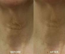 Image result for Neck Cream Before and After
