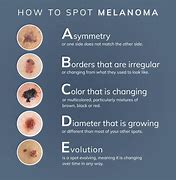 Image result for 4 Stages of Melanoma