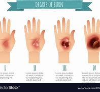 Image result for First-Degree Burn Cartoon
