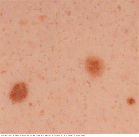 Moles - Symptoms and causes - Mayo Clinic