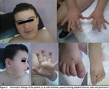 Image result for Xxyy Syndrome