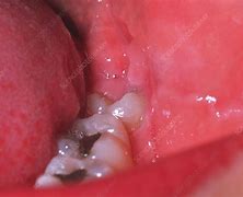 Image result for Wisdom Teeth Eruption