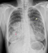 Image result for Metastatic Small Cell Lung Cancer