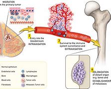 Image result for Secondary Metastatic Cancer