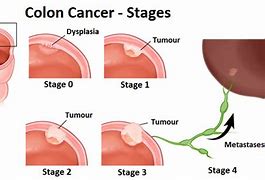 Image result for Different Stages of Colon Cancer