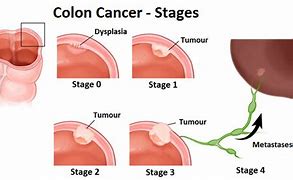 Image result for Stage 4 Colon Cancer