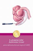 Image result for Lap Appendectomy Procedure