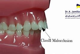Image result for Class II Malocclusion