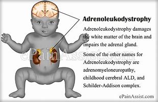 Image result for Adrenoleukodystrophy