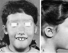 Image result for DiGeorge Syndrome Facial Features