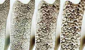 Image result for Osteoporosis Assignment Help