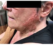 Image result for Healed Burn Scars