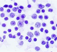 Image result for Small Cell Lung Cancer Cytology