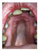 Image result for Marfan Syndrome Teeth