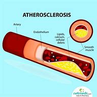 Image result for Atherosclerosis