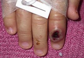 Image result for Monkeypox Symptoms