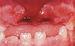 Image result for Dent Incisive