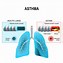 Image result for Asthma Physiology