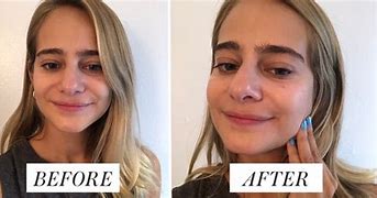 Image result for Hyaluronic Acid Serum Before and After