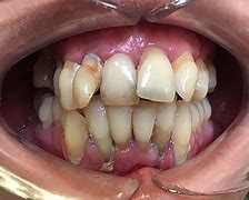 Image result for Poor Oral Hygiene