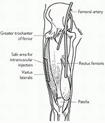 Image result for Intramuscular Injection Thigh
