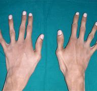 Image result for Person with Marfan Syndrome