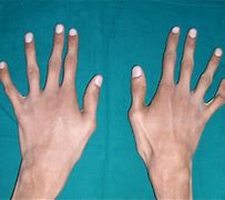 Image result for Signs of Marfan Syndrome