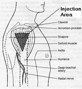 Image result for Intramuscular Injection Arm