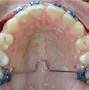 Image result for Bilateral Holding Arch