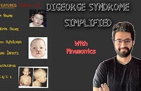 Image result for DiGeorge Syndrome Prognosis