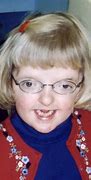 Image result for Famous People with Apert Syndrome