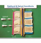 epidural 的图像结果