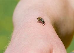 Image result for Bee Sting On Knee