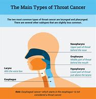 Image result for Stage 1 Throat Cancer