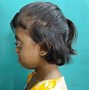 Image result for Crouzon Syndrome Women