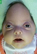 Image result for Pfeiffer Syndrome Life Expectancy Type 2