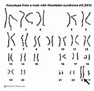 Image result for Male with Klinefelter Syndromekaryotype S