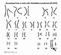Image result for Male with Klinefelter Syndrome Karyotype